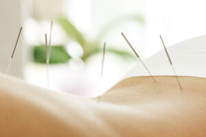 Bild på behandling med Akupunktur